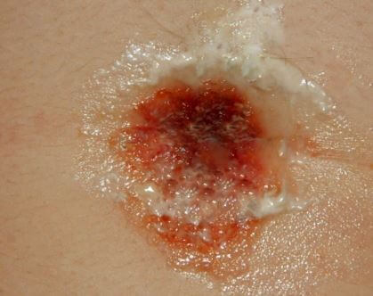 Infected Belly Button Piercing images2