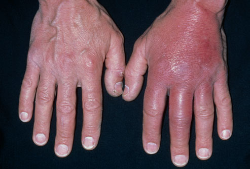 Cellulitis On Hands