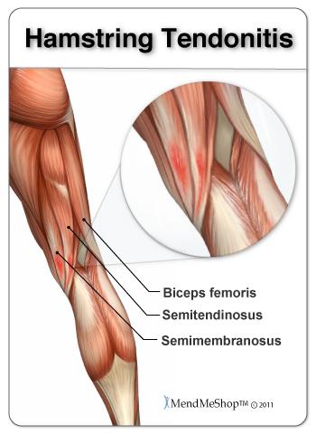 hamstring tendonitis