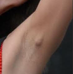 lump in armpit image