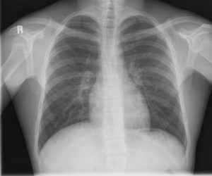 xray atelectasis bibasilar lungs radiography pulmonary radiology interpretations chestx importance findings copd fibrosis stepwards pathologies knowing basics radiografi myhealth ctsqena