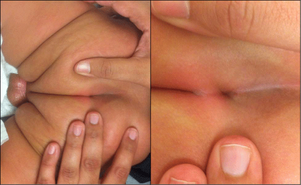 Sacral dimple with low depth