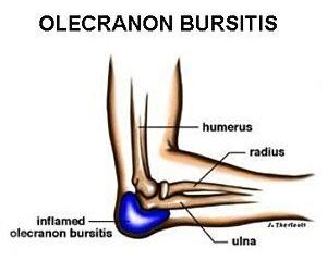 Olecranon Bursitis (elbow)