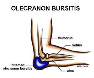 Olecranon Bursitis (elbow)