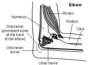 Olecranon Bursitis of elbow