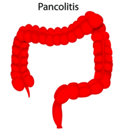 Pancolitis