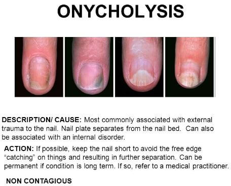 Onycholysis picture 1