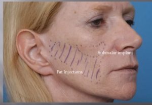 Lipoatrophy - Pictures, Causes, What Is, Treatment, Symptoms
