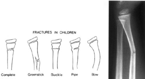 Types of greenstick fractures